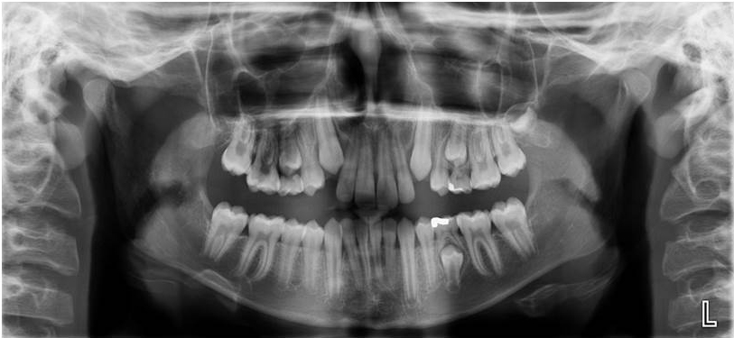 X-ray of the mouth